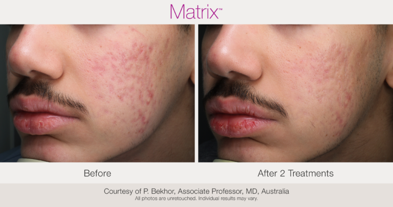 acne treatment Madison WI