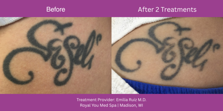 Laser tattoo removal before and after 2 treatments Madison WI — Royal You Med Spa
