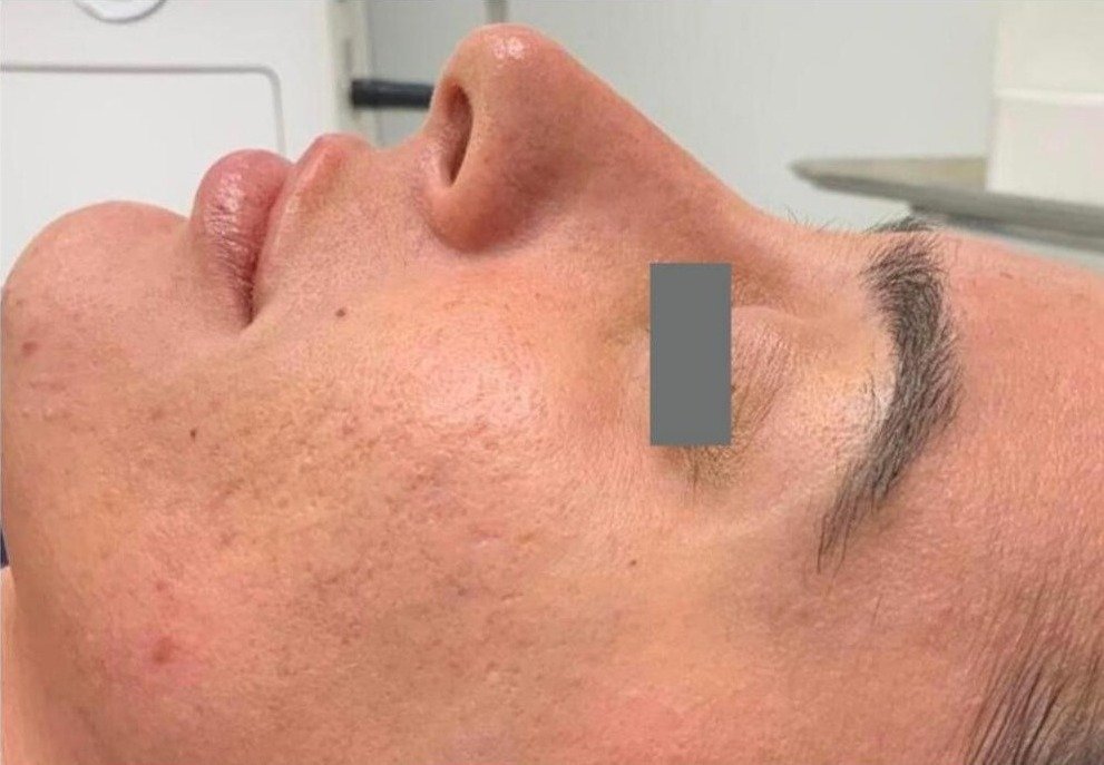 After 4 Matrix RF Microneedling acne treatments at Royal You Med Spa Madison WI