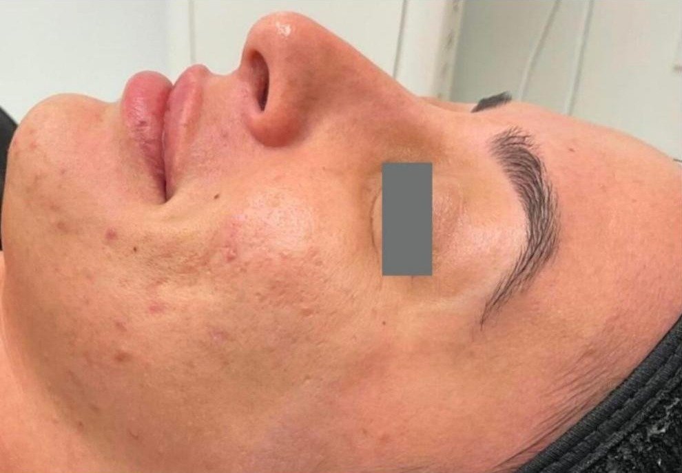 Before Matrix RF Microneedling acne treatment at Royal You Med Spa Madison WI