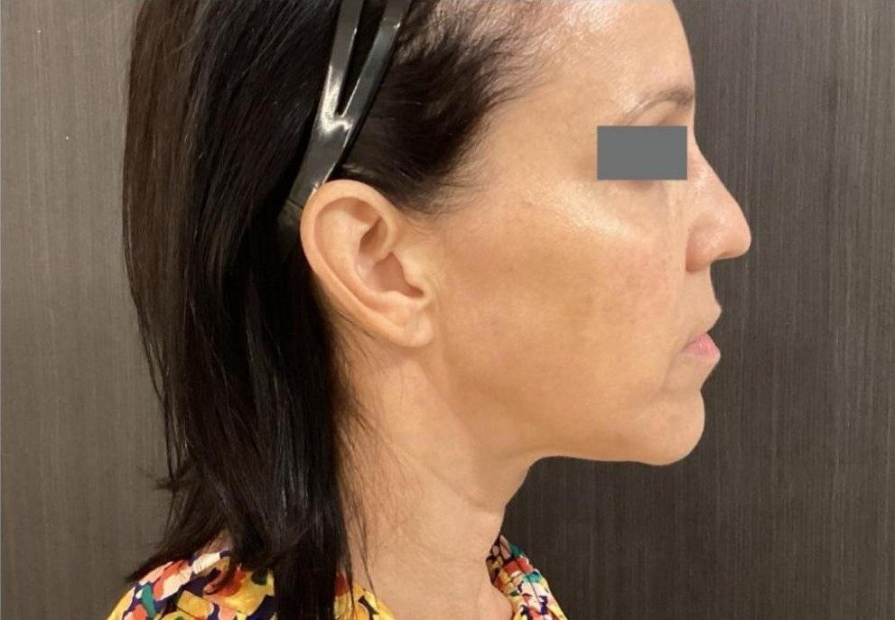 After 1 Matrix RF Microneedling treatment for skin laxity at Royal You Med Spa Madison WI
