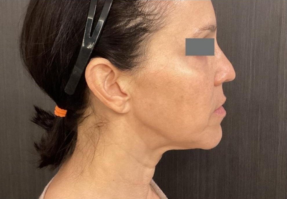 Before Matrix RF Microneedling skin laxity treatment at Royal You Med Spa Madison WI