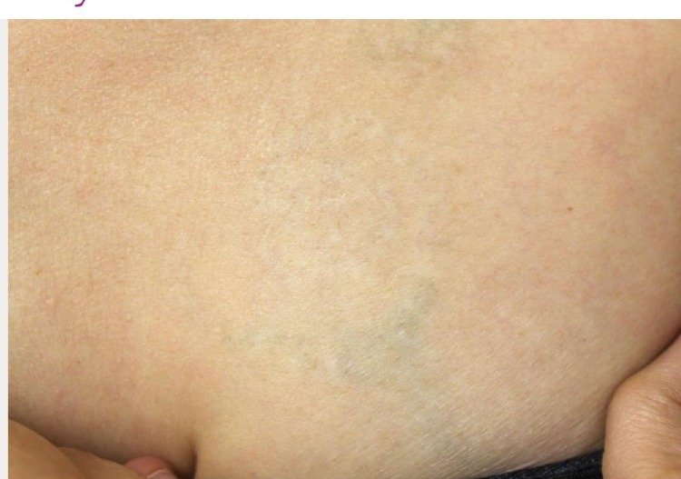 Tattoo after 9 PicoWay laser treatments at Royal You Med Spa Madison WI