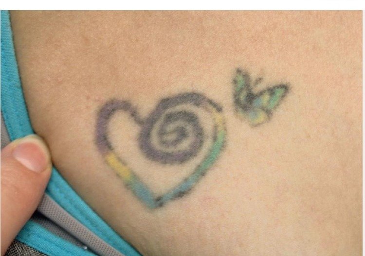 Tattoo before PicoWay laser removal treatment at Royal You Med Spa Madison WI