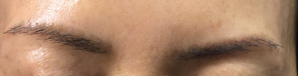Microblading removal after PicoWay laser treatment at Royal You Med Spa Madison WI