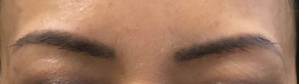 Microblading removal before treatment at Royal You Med Spa Madison WI