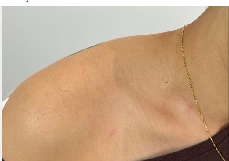 Tattoo after 4 PicoWay laser treatments at Royal You Med Spa Madison WI