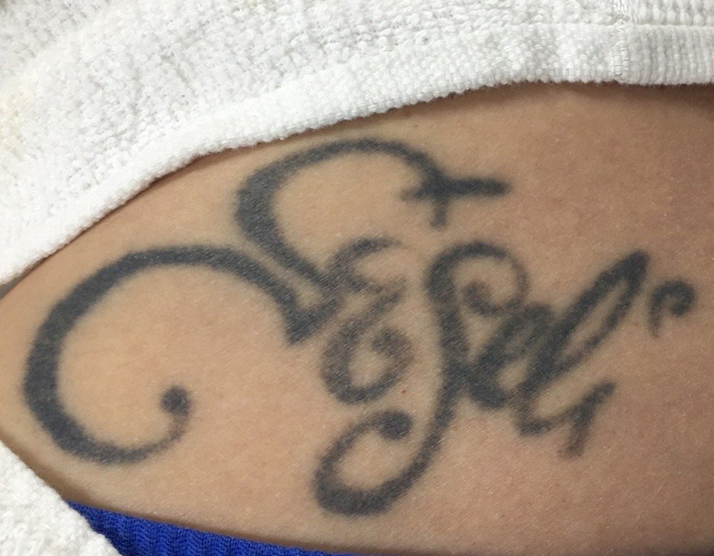 After 2 PicoWay laser tattoo removal treatments at Royal You Med Spa in Madison, WI