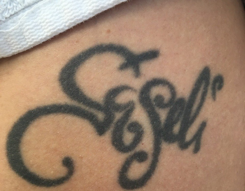 Before laser tattoo removal at Royal You Med Spa in Madison, WI