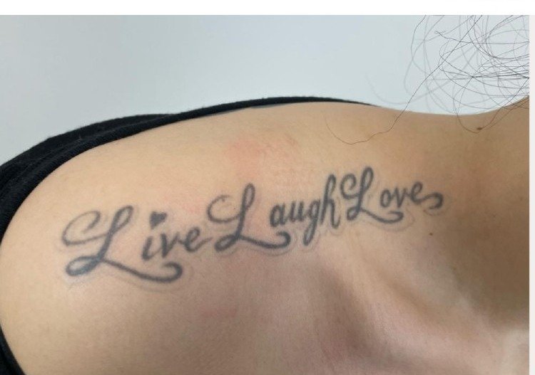 Tattoo before PicoWay laser removal treatment at Royal You Med Spa Madison WI